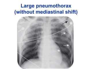 Large pneumothorax
(without mediastinal shift)
 