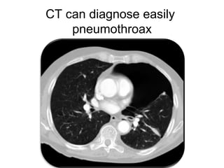 CT can diagnose easily
pneumothroax
 