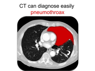 CT can diagnose easily
pneumothroax
 