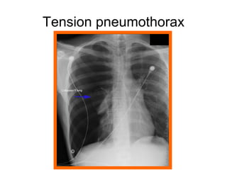 Tension pneumothorax
 