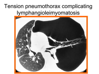 Tension pneumothorax complicating
lymphangioleimyomatosis
 