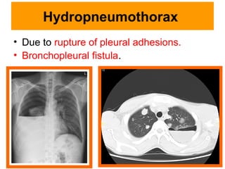 Hydropneumothorax
• Due to rupture of pleural adhesions.
• Bronchopleural fistula.
 