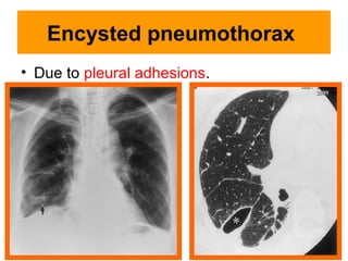 Encysted pneumothorax
• Due to pleural adhesions.
 