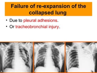 Failure of re-expansion of the
collapsed lung
• Due to pleural adhesions.
• Or tracheobronchial injury.
 
