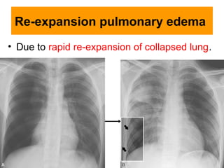 Re-expansion pulmonary edema
• Due to rapid re-expansion of collapsed lung.
 