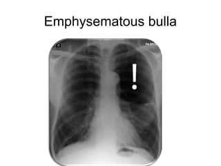 Emphysematous bulla
 