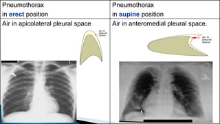 Pneumothorax 
in erect position 
Pneumothorax 
in supine position 
Air in apicolateral pleural space Air in anteromedial pleural space. 
 