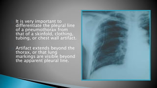 It is very important to 
differentiate the pleural line 
of a pneumothorax from 
that of a skinfold, clothing, 
tubing, or chest wall artifact. 
Artifact extends beyond the 
thorax, or that lung 
markings are visible beyond 
the apparent pleural line. 
 