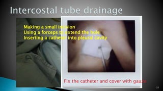 31 
Making a small incision 
Using a forceps to extend the hole 
Inserting a catheter into pleural cavity 
Fix the catheter and cover with gauze 
 