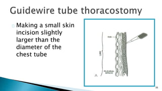 36 
Making a small skin 
incision slightly 
larger than the 
diameter of the 
chest tube 
 