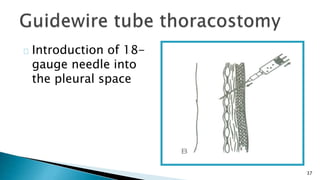 37 
Introduction of 18- 
gauge needle into 
the pleural space 
 