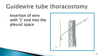 38 
Insertion of wire 
with “J” end into the 
pleural space 
 