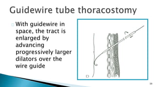 39 
With guidewire in 
space, the tract is 
enlarged by 
advancing 
progressively larger 
dilators over the 
wire guide 
 