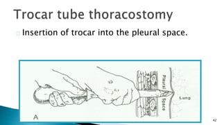 42 
Insertion of trocar into the pleural space. 
 