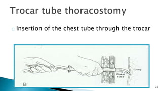43 
Insertion of the chest tube through the trocar 
 