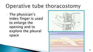 44 
The physician’s 
index finger is used 
to enlarge the 
opening and to 
explore the pleural 
space 
 