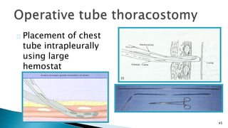 45 
Placement of chest 
tube intrapleurally 
using large 
hemostat 
 