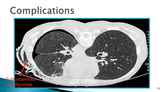 55 
Subcutaneous 
emphysema 
 
