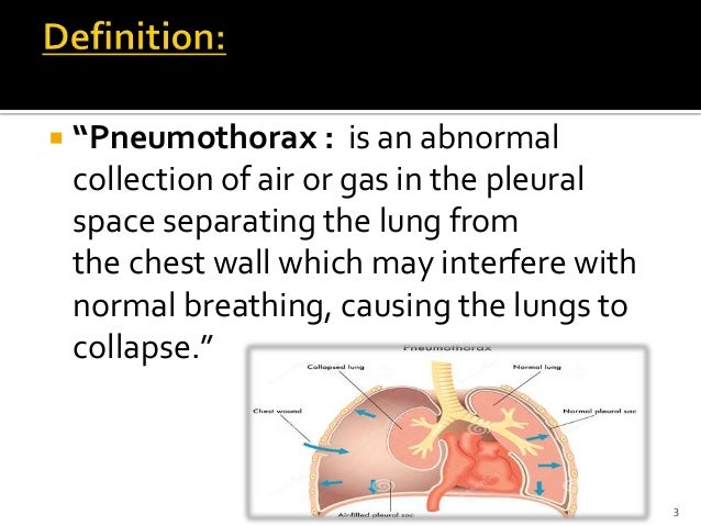 A spontaneous pneumothorax is that which occurs in the absence of an external event. Pneumothorax Different Types : Pneumothorax