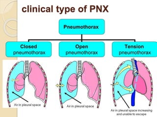 11
clinical type of PNX
Pneumothorax
Closed
pneumothorax
Open
pneumothorax
Tension
pneumothorax
 