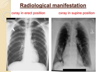 Radiological manifestation
cxray in erect position cxray in supine position
16
 