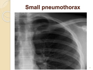 Small pneumothorax
17
 