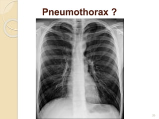 20
Pneumothorax ?
 