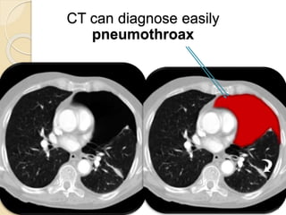 24
CT can diagnose easily
pneumothroax
 