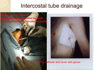 37
37
Intercostal tube drainage
Fix the catheter and cover with gauze
Making a small incision
Using a forceps to extend the hole
Inserting a catheter into pleural cavity
 