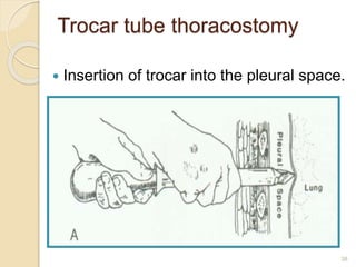 38
Trocar tube thoracostomy
 Insertion of trocar into the pleural space.
 