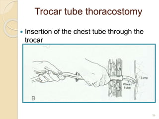 39
Trocar tube thoracostomy
 Insertion of the chest tube through the
trocar
 