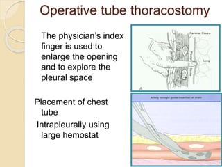 4
Operative tube thoracostomy
The physician’s index
finger is used to
enlarge the opening
and to explore the
pleural space
Placement of chest
tube
Intrapleurally using
large hemostat
 
