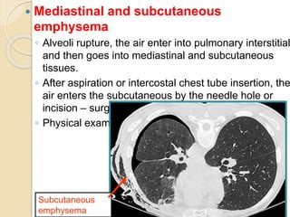 51
 Mediastinal and subcutaneous
emphysema
◦ Alveoli rupture, the air enter into pulmonary interstitial
and then goes into mediastinal and subcutaneous
tissues.
◦ After aspiration or intercostal chest tube insertion, the
air enters the subcutaneous by the needle hole or
incision – surgical emphysema
◦ Physical exam – crepitus is present.
Subcutaneous
emphysema
 