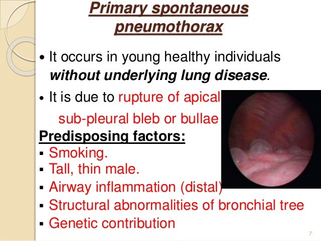 spontaneous pneumothorax Spontaneous pneumothorax: no clinical signs or symptoms in primary spontaneous pneumothorax until a bleb ruptures and causes pneumothorax typically, the result is acute onset of chest pain and shortness of breath, particularly with secondary spontaneous pneumothoraces. spontaneous pneumothorax Spontaneous pneumothorax: no clinical signs or symptoms in primary spontaneous pneumothorax until a bleb ruptures and causes pneumothorax typically, the result is acute onset of chest pain and shortness of breath, particularly with secondary spontaneous pneumothoraces.