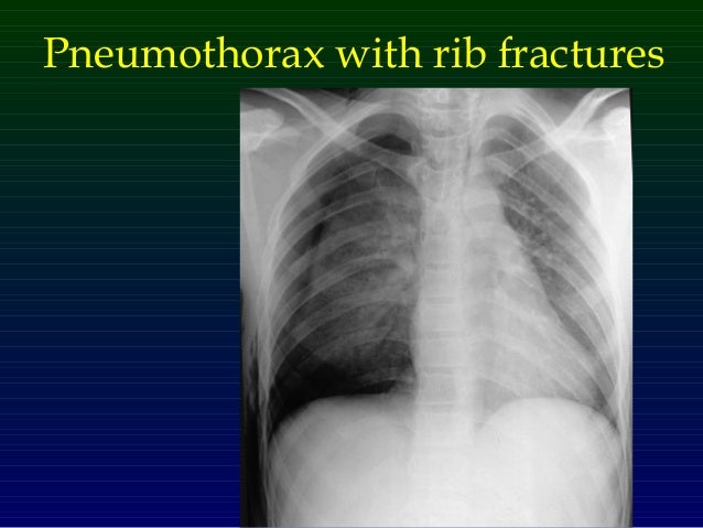 Rib Fracture Pneumothorax