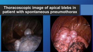 Thoracoscopic image of apical blebs in
patient with spontaneous pneumothorax
 
