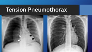 Tension Pneumothorax
 