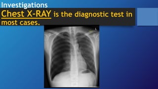 Investigations
Chest X-RAY is the diagnostic test in
most cases.
 