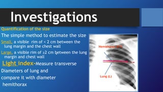 Investigations
Quantification of the size
The simple method to estimate the size
Small, a visible rim of < 2 cm between the
lung margin and the chest wall
Large, a visible rim of ≥2 cm between the lung
margin and chest wall
Light index-Measure transverse
Diameters of lung and
compare it with diameter
hemithorax
28
Hemithorax (HT)
Lung (L)
 