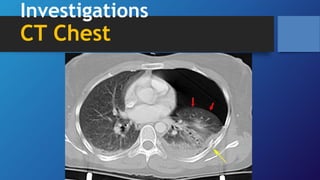 Investigations
CT Chest
 