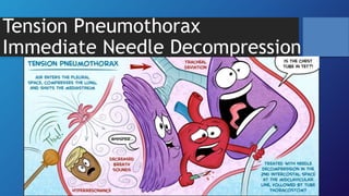 Tension Pneumothorax
Immediate Needle Decompression
 