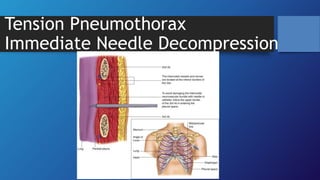 Tension Pneumothorax
Immediate Needle Decompression
 