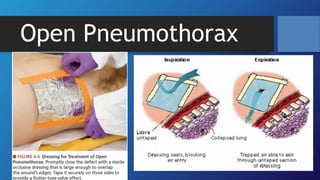 Open Pneumothorax
 