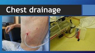 Chest drainage
 
