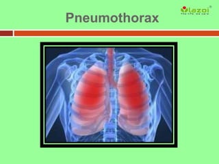 Pneumothorax
 