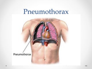 4
Pneumothorax
 