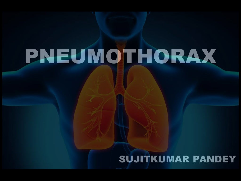 Pneumothorax PPT