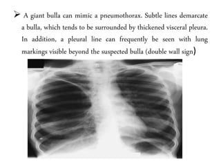  A giant bulla can mimic a pneumothorax. Subtle lines demarcate
a bulla, which tends to be surrounded by thickened visceral pleura.
In addition, a pleural line can frequently be seen with lung
markings visible beyond the suspected bulla (double wall sign)
 