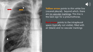 Yellow arrow points to thin white line
(visceral pleural), beyond which, there
are no vascular markings. This line is
the best sign for a pneumothorax.
Red arrow points to the intrapleural
space (typically not visible), filled with
air (black) and no vascular markings
 