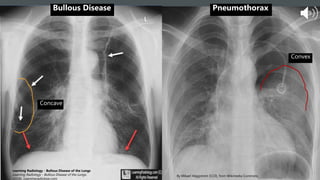 Convex
Concave
By Mikael Häggström [CC0], from Wikimedia Commons
Learning Radiology - Bullous Disease of the Lungs
Learning Radiology - Bullous Disease of the Lungs.
(2018). Learningradiology.com.
Bullous Disease Pneumothorax
 